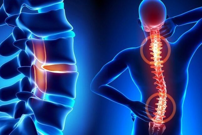spinal pain with lumbar osteochondrosis