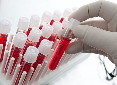 blood test for the diagnosis of arthritis and osteoarthritis