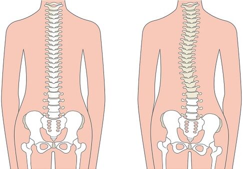 Lower back pain due to spinal deformity such as scoliosis
