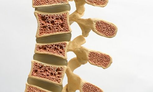 Osteoporosis is one of the causes of low back pain