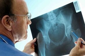 Hip Articulation Arthrosis in X -ray