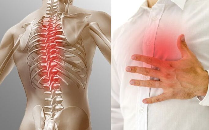 Thoracic osteochondrosis and chest pain