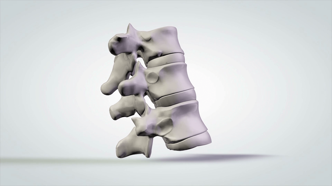 damage to the spine due to cervical osteochondrosis